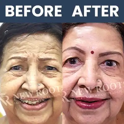 Botox Result -2